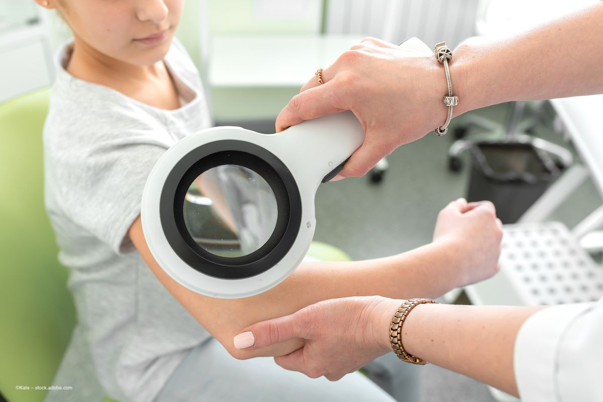 A dermatologist examines a child's arm for evidence of atopic dermatitits. Concept image for link between AD and paediatric uveitis. Image credit: ©Kate – stock.adobe.com