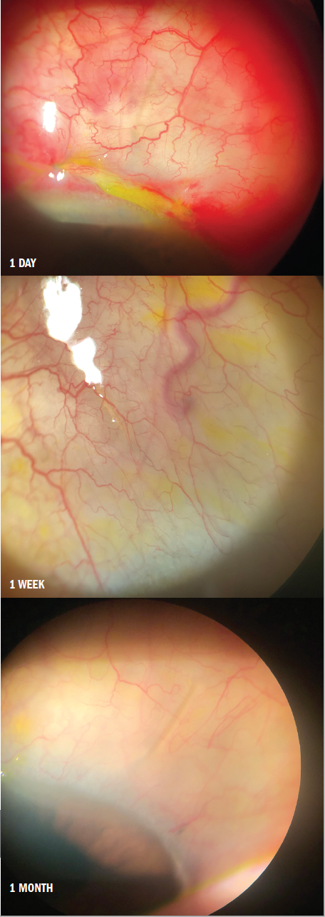 A postoperative look at a Xen eye at 1 day, 1 week and 1 month. (Image courtesy of Dr Paul Singh)