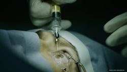 Applying cryopreserved amniotic membrane following intravitreal injection