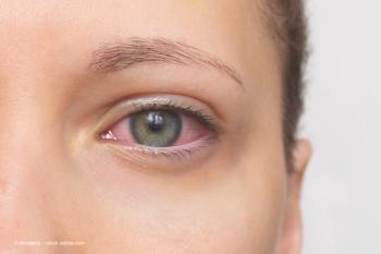A close-up photo of a woman with red, inflamed eyes. Her eye is swollen and blood vessels are visible. Image credit: ©Janeberry – stock.adobe.com