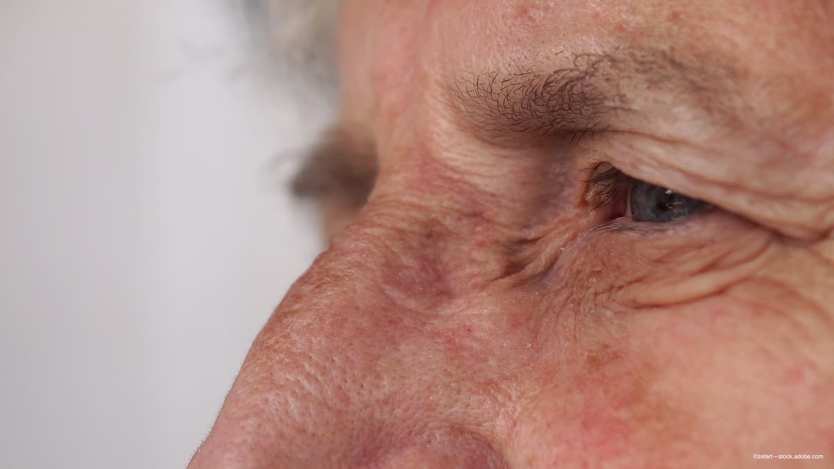 Exploring the clinical and humanistic burden of geographic atrophy