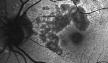 Hypoautofluorescence outlines an area of atrophy.