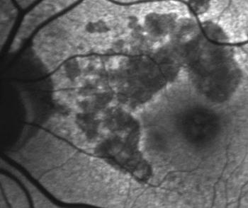 Hypoautofluorescence outlines an area of atrophy.