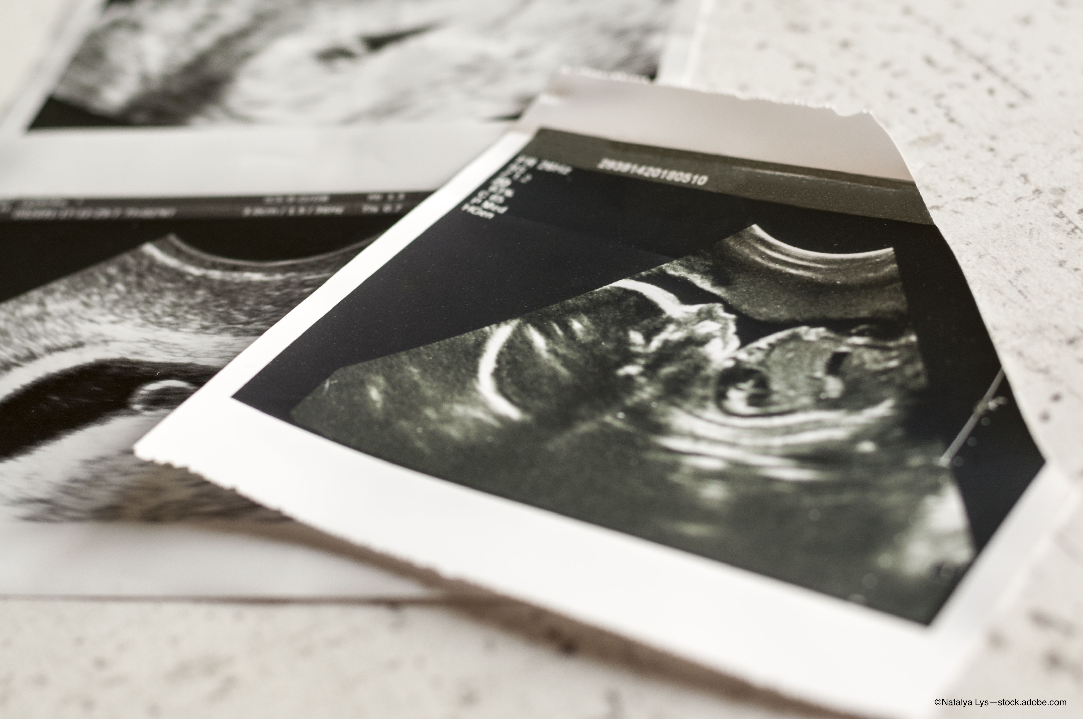 Diabetes during pregnancy linked to high refractive error in offspring