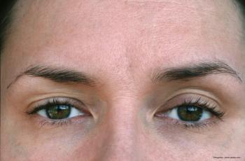 Shedding light on Horner’s syndrome