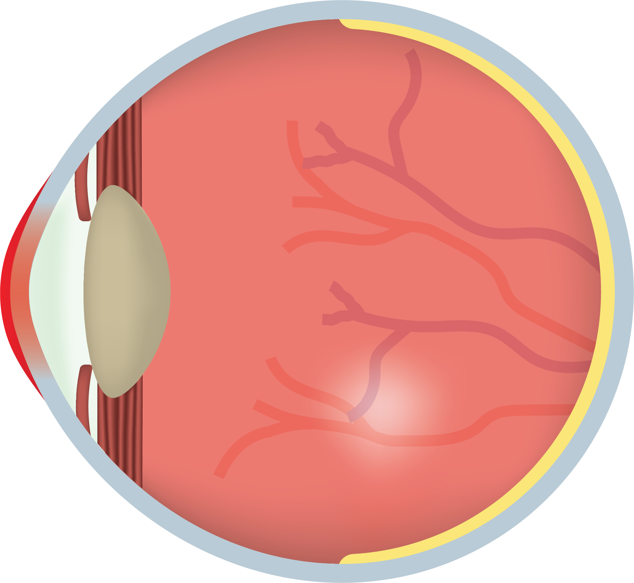 Illustration showing dry eye