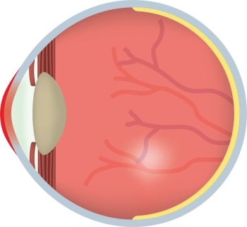 Illustration showing dry eye