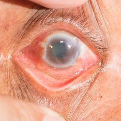 A doctor's hand pulls a glaucoma patient's upper eyelid up to examine the cornea