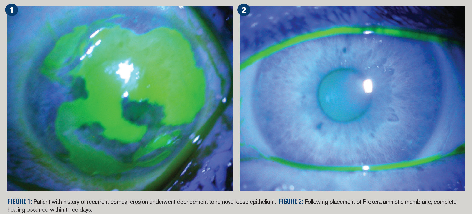 Go Beyond Medical Treatment For Recurrent Corneal Erosion Go Beyond Medical Treatment For Recurrent Corneal Erosion