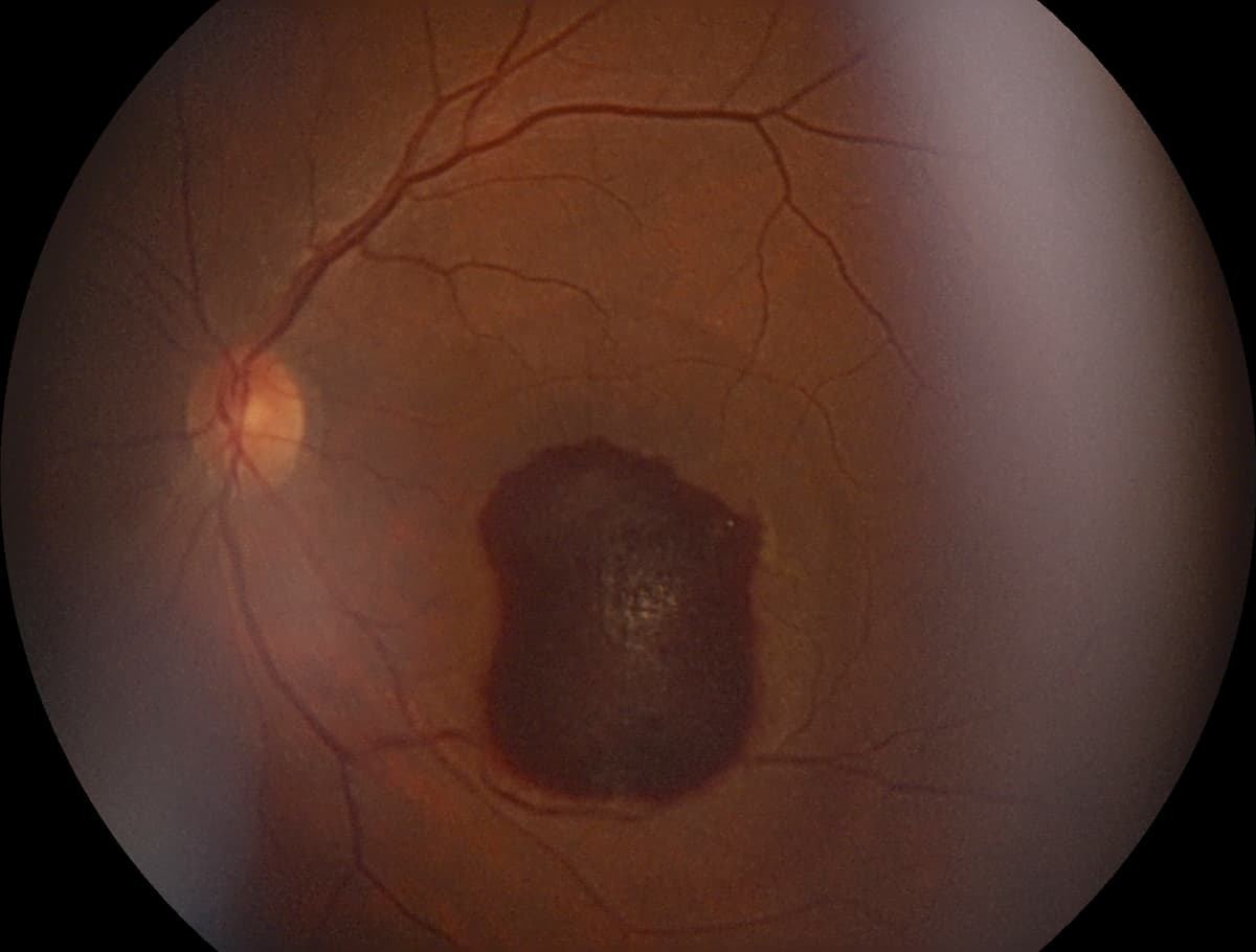 Retinal lesion Image credit: AdobeStock/Mohammed