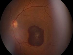 Retinal lesion Image credit: AdobeStock/Mohammed
