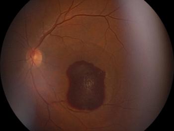 Retinal lesion Image credit: AdobeStock/Mohammed