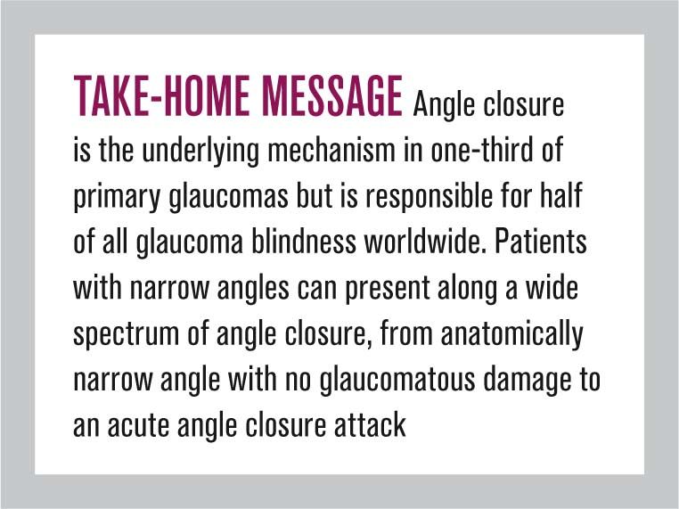 Diagnosing and managing patients with narrow angles Diagnosing and managing patients with narrow angles