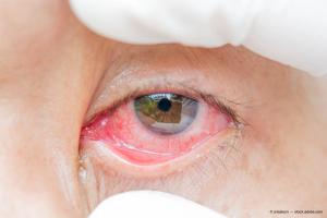 How to manage adenoviral conjunctivitis
