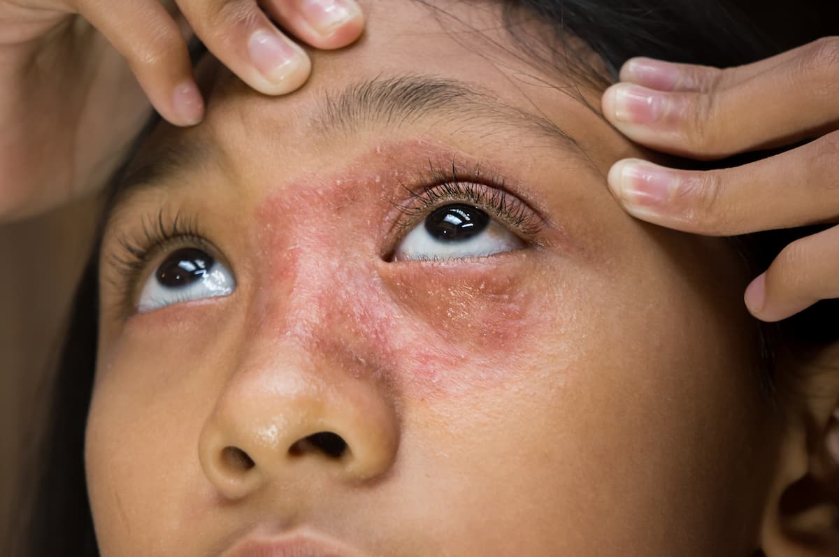Woman with dermatitis on face Image credit: AdobeStock/AmpYangImages