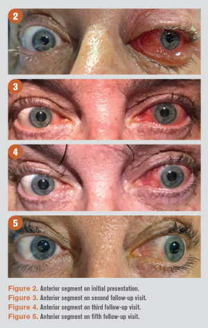Differential key to diagnosing idiopathic orbital inflammation