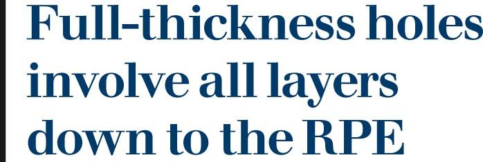 Identifying common macular conditions with OCT