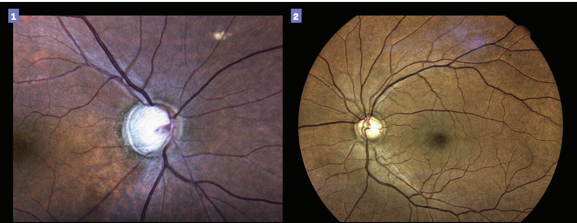 New treatments and surgeries are transforming the glaucoma