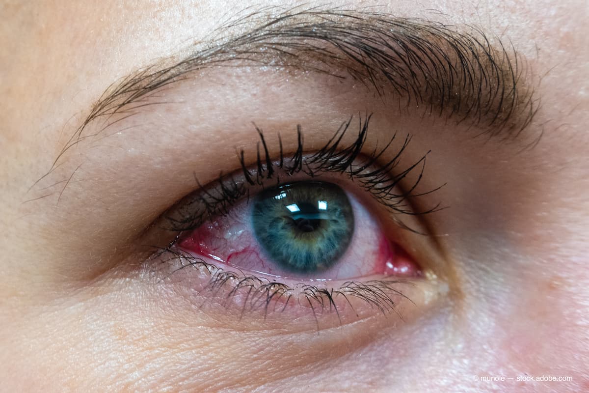 Can cyclosporine solutions be used to treat allergic conjunctivitis? 