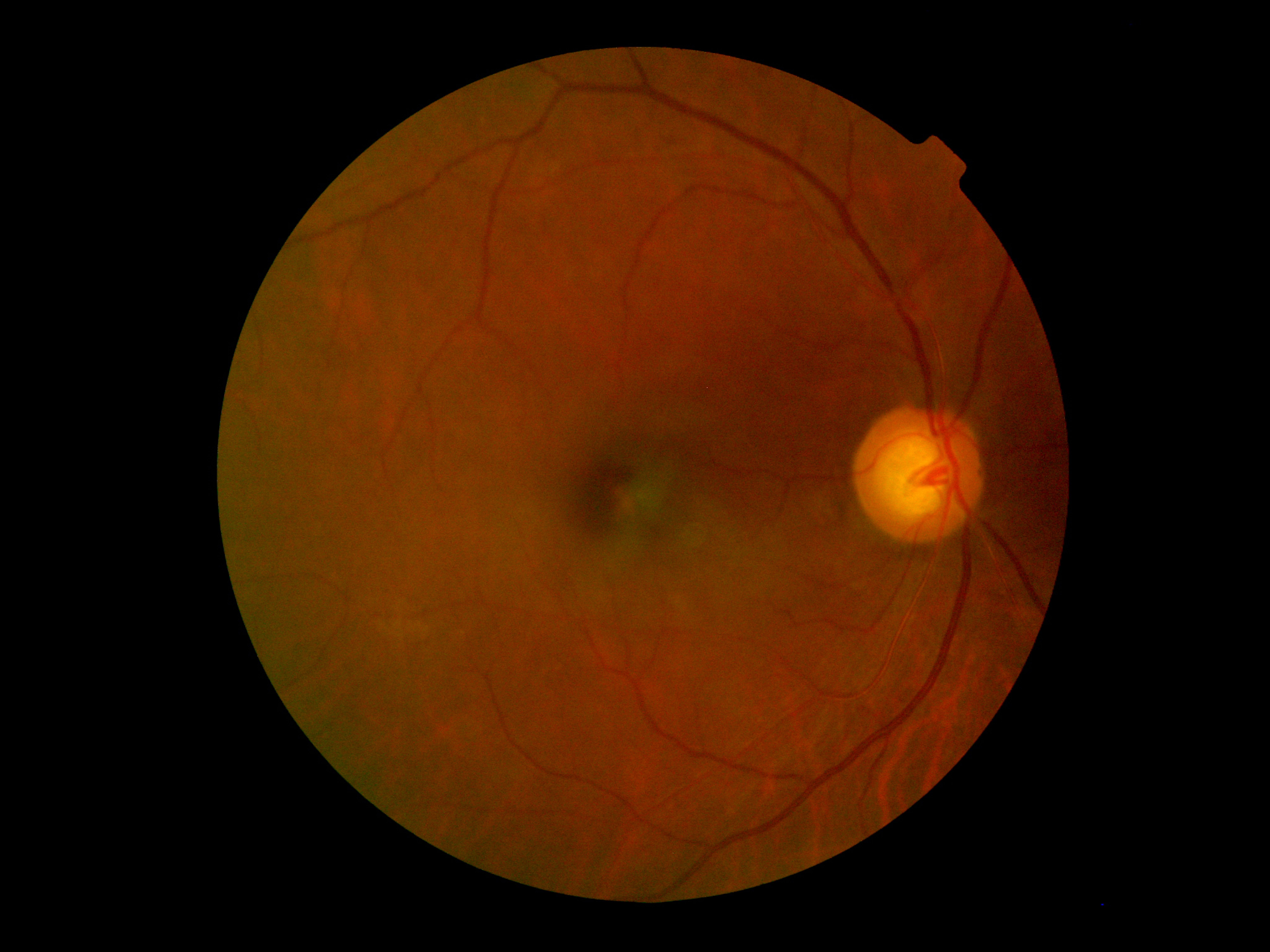 Figure 1: A fundus photograph of the patient’s right posterior pole imaged throu