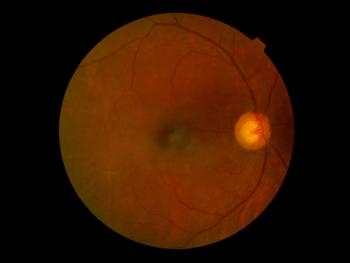 Figure 1: A fundus photograph of the patient’s right posterior pole imaged throu