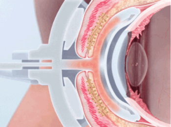 Johnson & Johnson Vision introduces next-gen MGD treatment following positive study outcomes