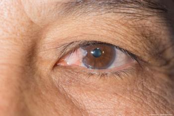 Pterygium in patient eye Image credit: ©arztsamui - adobe.stock.com