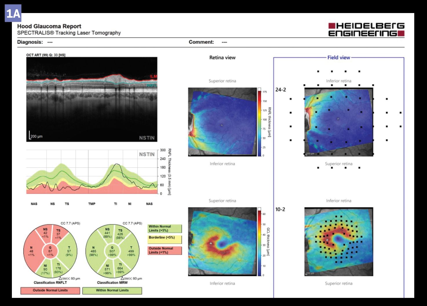 OCT is a crucial tool in glaucoma diagnosis and monitoring