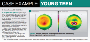 Best practices for managing keratoconus patients