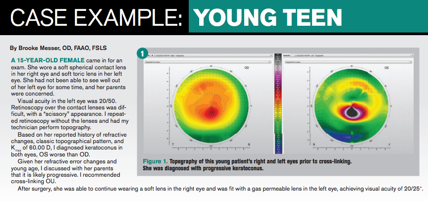 Best Practices For Managing Keratoconus Patients