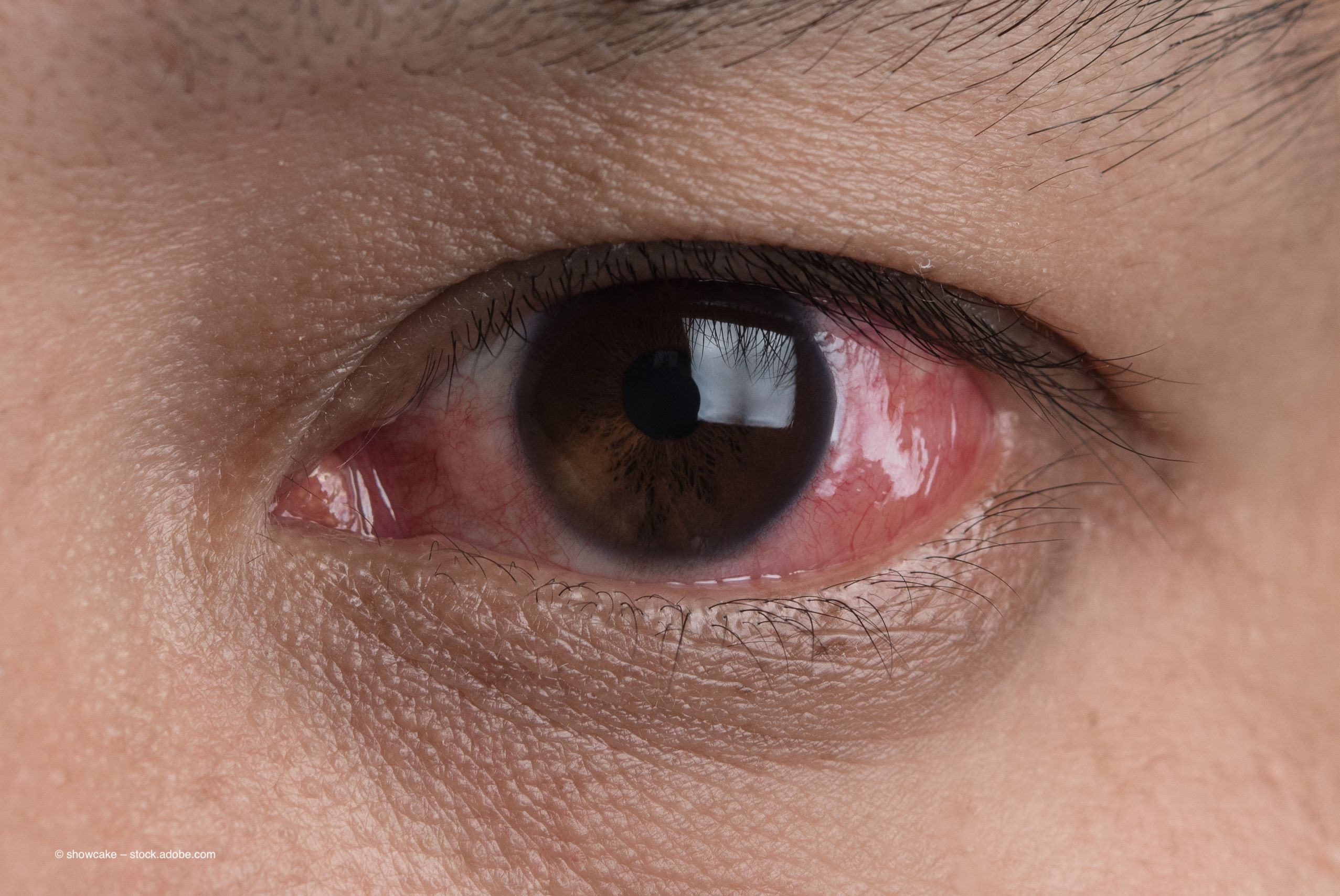 Study: potential biologic may treat allergic eye disease