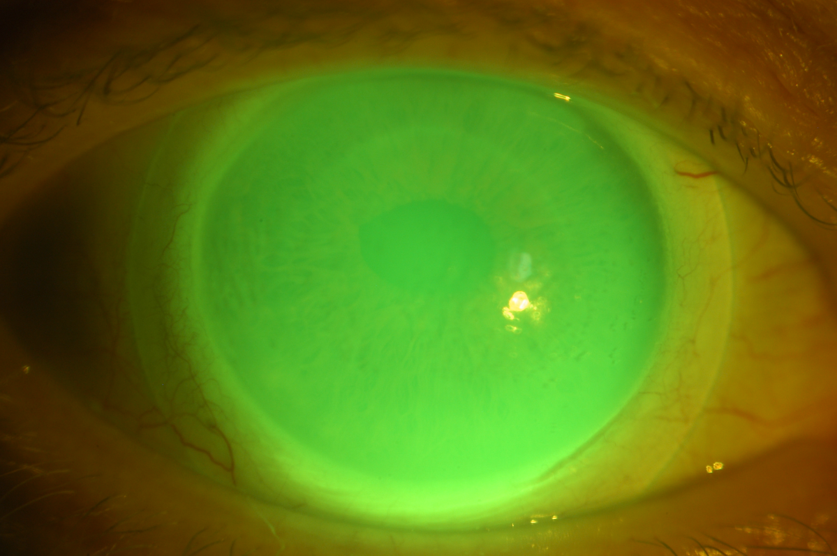 Figure 1. A scleral contact lens (with NaFl) on an eye with a corneal graft. Pho