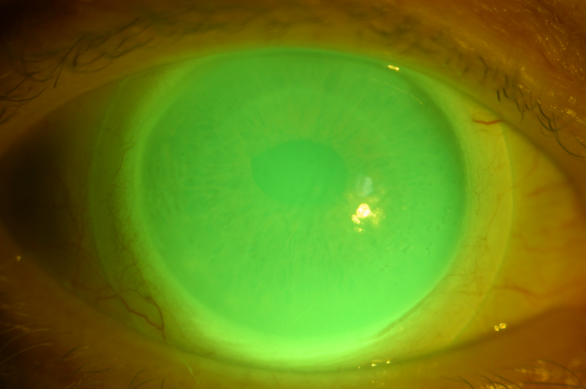 Figure 1. A scleral contact lens (with NaFl) on an eye with a corneal graft. Pho