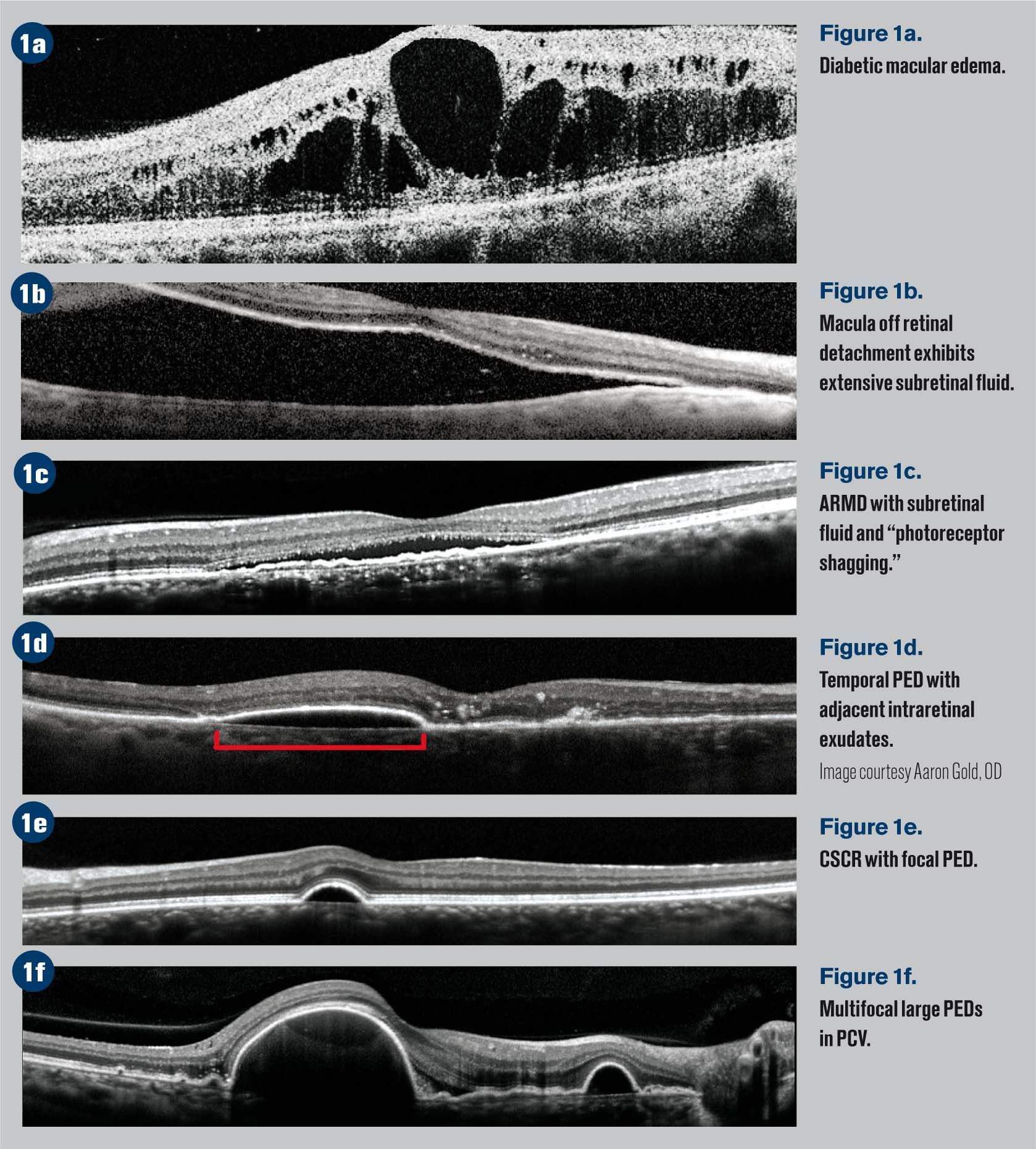 macular edema oct