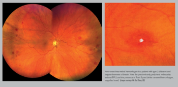 Retinal hemorrhages
