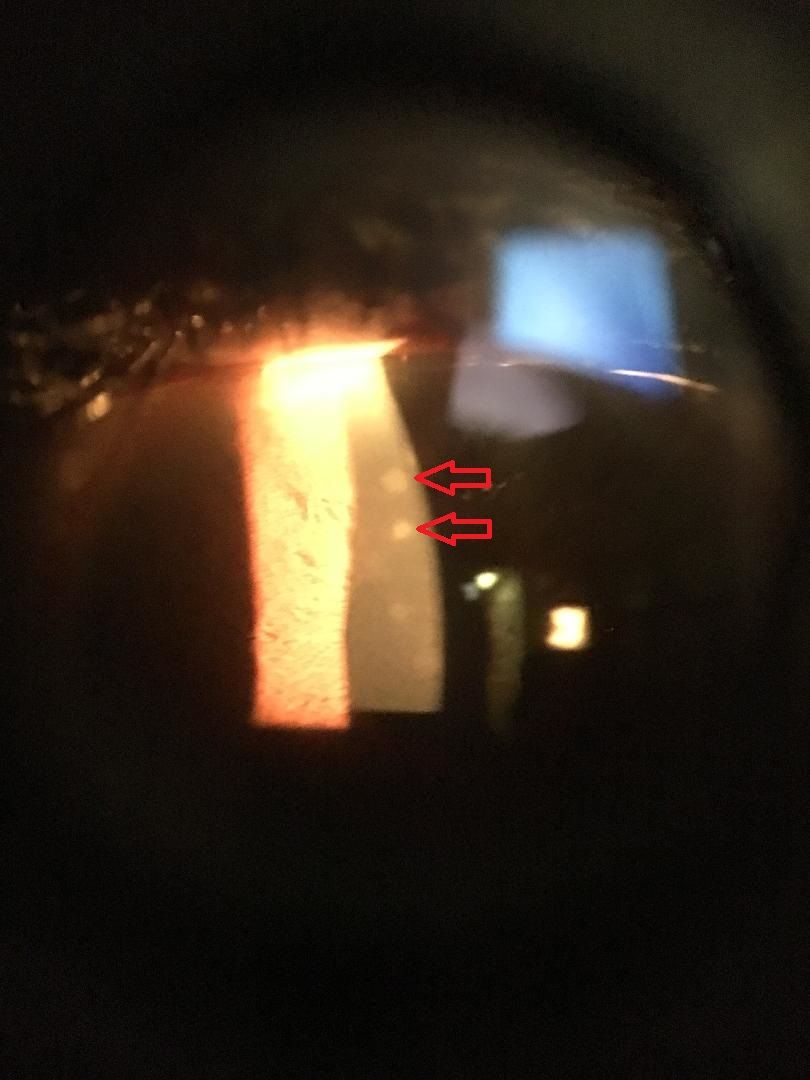 Corneal scars in a soft contact lens wearer indicating previous complications.  