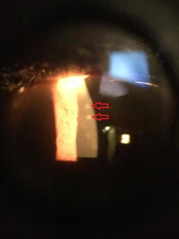 Corneal scars in a soft contact lens wearer indicating previous complications.  