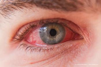 Macro closeup of conjunctivitis infeced red eye (Adobe Stock / Audrius Merfeldas)
