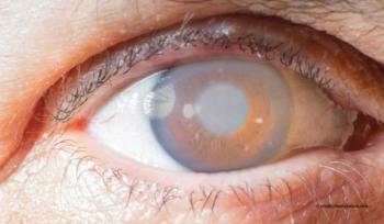 eye with glaucoma