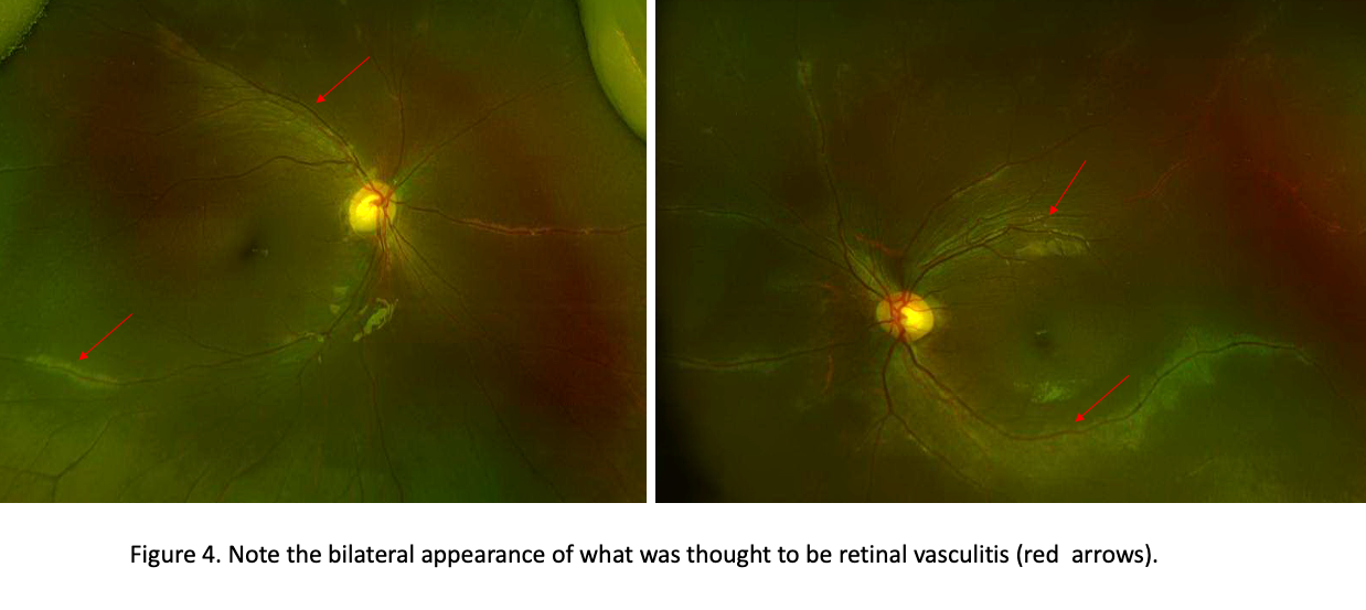 Genetic Testing: Simplifying The Diagnoses Of Inherited Retinal Diseases