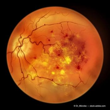 Diabetic retinopathy, ophthalmoscopic diagnosis, illustration (Adobe Stock / Dr_Microbe)