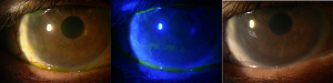  Amniotic membrane grafts help ocular surface disease