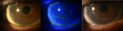 Amniotic membrane grafts help ocular surface disease
