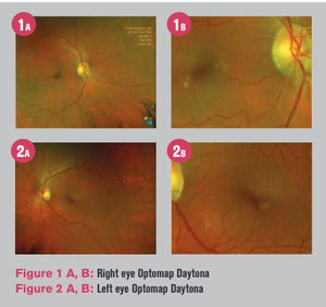 More than a yellow lesion? 