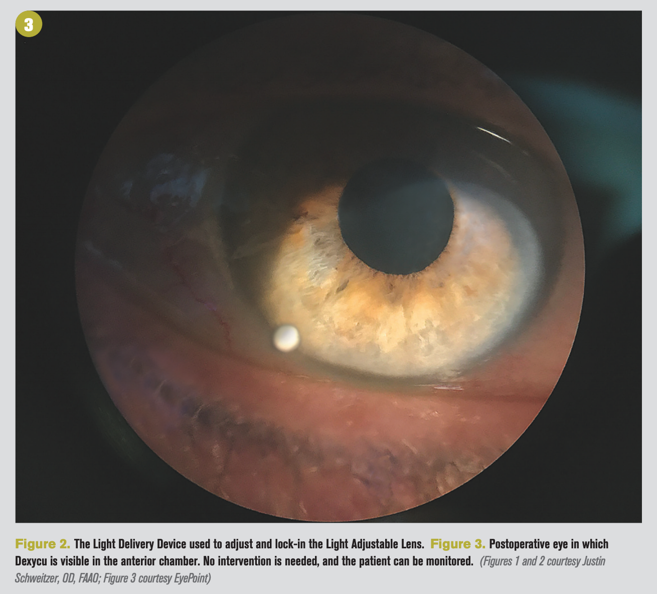 Flashing White Light After Cataract Surgery Shelly Lighting   207de270d6ea251f3ffa4475ebed4591c0585200 1310x1184 