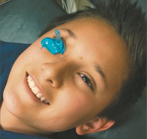 Fit pediatric cones with impression-based prosthetic scleral lenses