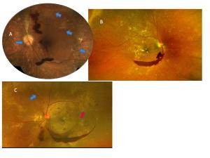 Improve your detection rate of retinal neovascularization