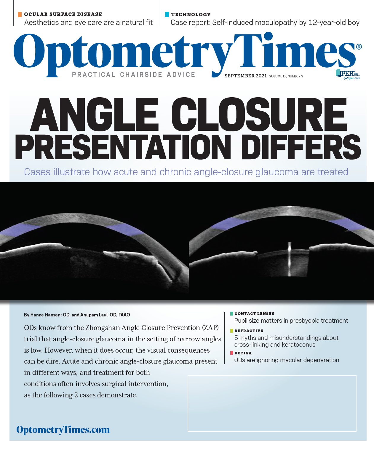 Canadian Association of Optometrists on X: Early signs of  #maculardegeneration can include waviness, distortion, blurring or missing  areas on the Amsler grid. These changes may indicate a problem or worsening  of #AMD.