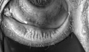 How to address the three aspects of dry eye disease