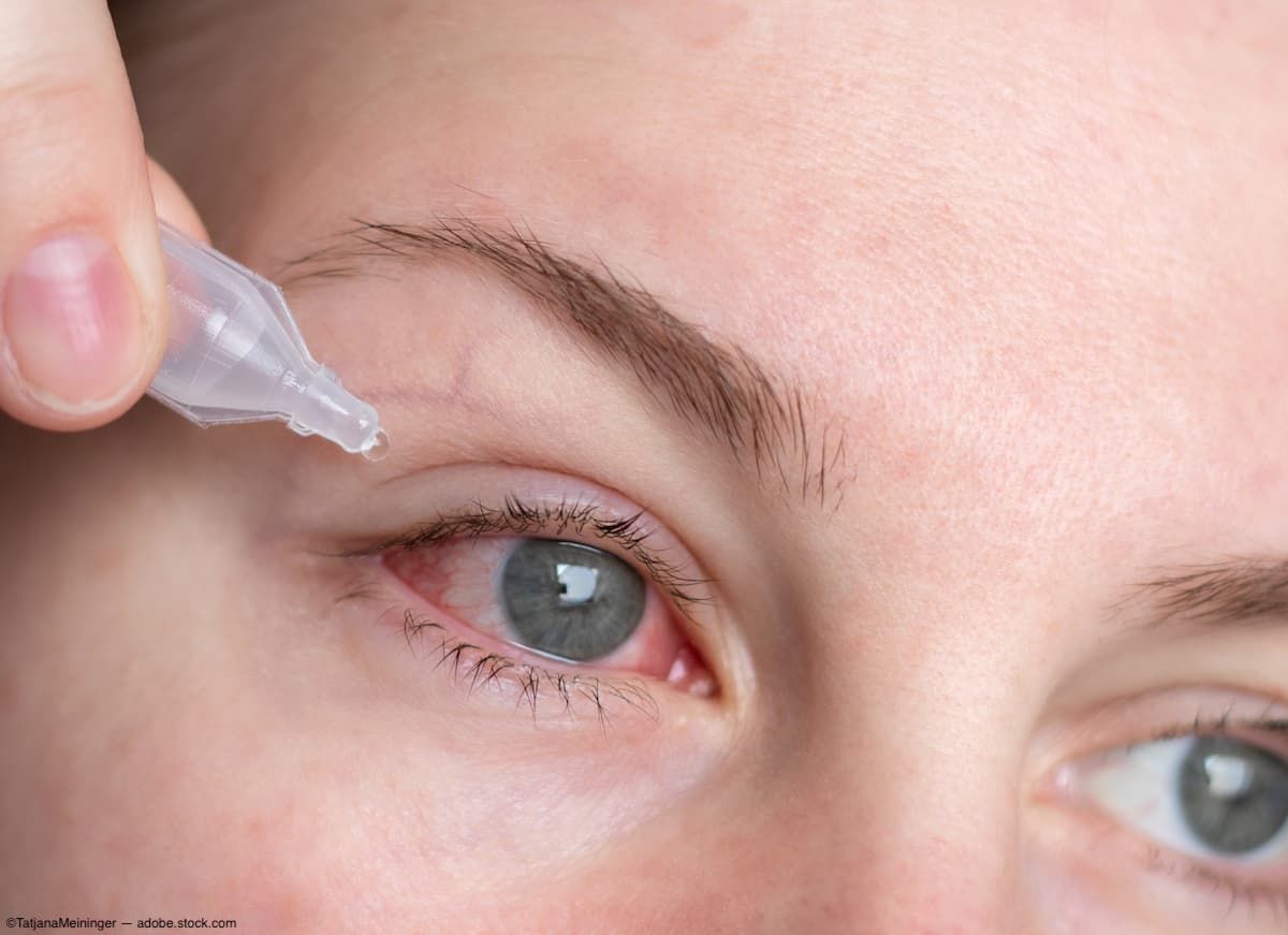 Woman administering eye drops Image credit: AdobeStock/TatjanaMeininger
